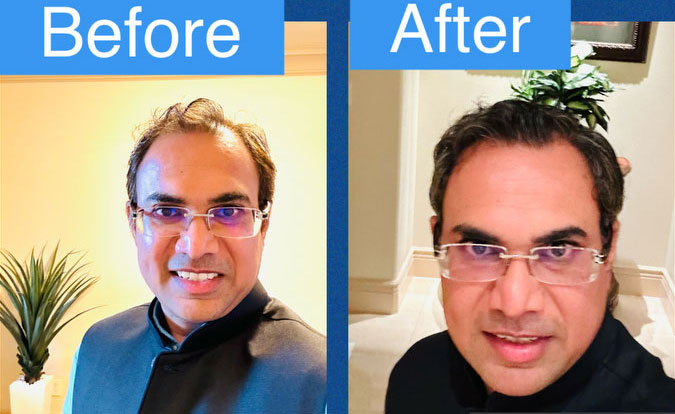 Before-and-After-with-Imag22e-Courtesy.Dr-Kuhadiya