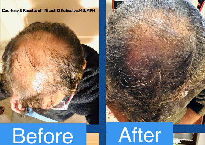 Before-and-After-with-Image-Courtesy.Dr-Kuhadiya